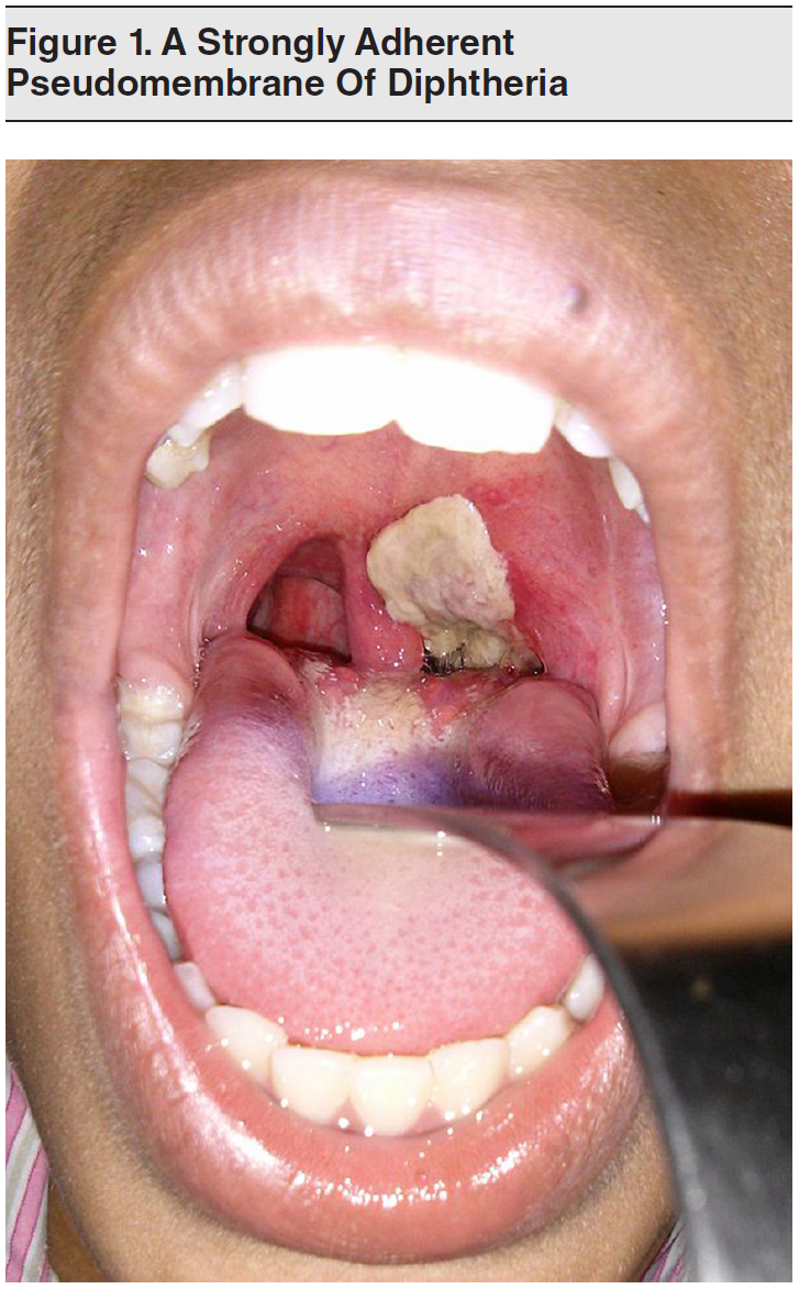 Tables And Figures Diphtheria, Pertussis, And Tetanus